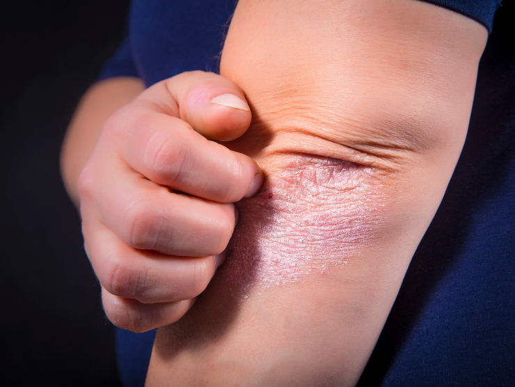 Behandla hudproblem med Medicinsk Laser